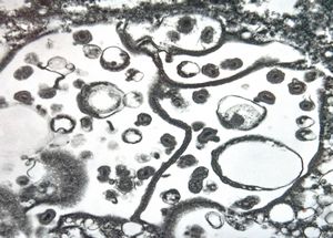 cytomegalovirus - pneumonia cytomegalovirus - pneumonia